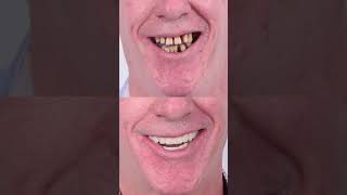 Antes y después del implante dental implantedental dientes madrid [upl. by Rairb]