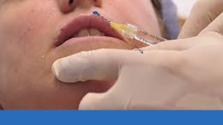 Riempimento labbra con Filler acido ialuronico  Guida Completa Medicina Estetica [upl. by Januarius583]