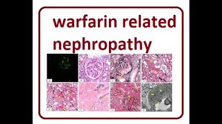 Warfarin Related Nephropathy  2024 [upl. by Ansela369]