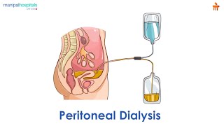 What is Peritoneal dialysis l Manipal Hospitals Bengaluru [upl. by Anomas791]