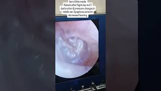 Aero Otitis Media in Patient after flight due to Eustachian tube dysfunction amp pressure changes [upl. by Belda]