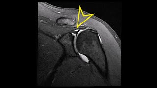 Shoulder MRI Labral SLAP Superior Labrum Anterior Posterior Tear [upl. by Yellac]