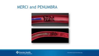 Acute Ischemic Stroke Treatment 2015 by Esteban ChengChing MD [upl. by Feldt905]