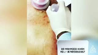 Back Acne Scars Treatment [upl. by Kehr]