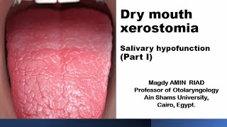 Dry mouth xerostomia Salivary hypofunction Part I [upl. by Ennairak]