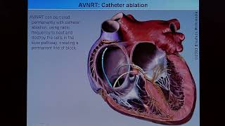 4 Ablation der AV Knotentechykardie [upl. by Vincentia]