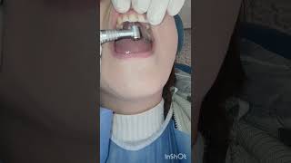 طبييب الاسنان ي dentist stitch اكسبلور عالج جذور الاسنان [upl. by Kalil850]