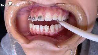 Dental BRACES with Dr Williams  What to Expect at your first appointment [upl. by Aylat66]