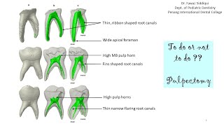 Challenges in pulpectomy [upl. by Adhamh]