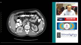 CT of Perforated Sigmoid Diverticulitis by Dr Arjun Kalyanpur [upl. by Aihk10]