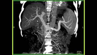 Abdomen Liver Cirrhosis MIP Maximum intensity projection of a cirrhotic liver with collaterals [upl. by As]