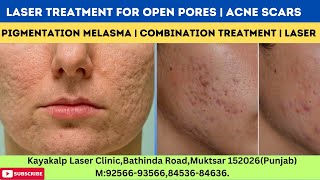 Laser Treatment for Open Pores  Acne Scars  Pigmentation  Melasma  Combination Treatment  Laser [upl. by Lundt]