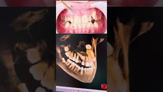 Impacted canine treatment without teeth extraction big change of the aesthetic angles of the face [upl. by Aciemaj366]