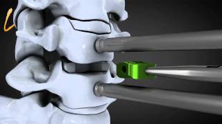 Hernie discale cervicale  Spinal disk herniation  Kisco International [upl. by Eittel]