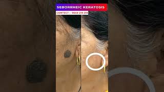 Seborrheic Keratosis treatment at Skinaa clinic viralshorts serborrheickeratosis skinaaclinic [upl. by Atineb]