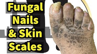 Fungal Nails amp Skin Scales An Elderly Patient Needs Foot Care [upl. by Ailemor]