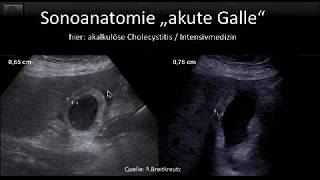 DProbleme Gallenblase und wege Worauf bd fokussierten Sonographie achten von Claudia Schrader [upl. by Ahsimed79]