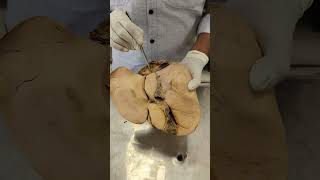 LIVERQuadrate ampCaudate Lobes shorts anatomy shortsyoutubeindia shortsyoutube liver hepatic [upl. by Ilram]