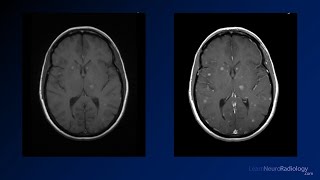 Neuroradiology board review 3 case 5 [upl. by Per603]