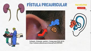 FÍSTULA PREAURICULAR [upl. by Wyndham]