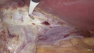 Laparoscopic cholecystectomy unedited 1982024 [upl. by Arodnahs]