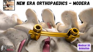 New Era Orthopaedics Modera  Medical Animation 3D Video  BiologywithAliya [upl. by Netsew]