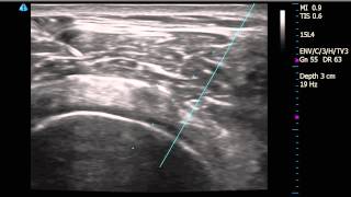 Right Shoulder Subacromial Bursitis diagnosed by Ultrasound with injection [upl. by Aliuqa]