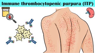 Immune Thrombocytopenic Purpura ITP  Causes Pathogenesis Signs amp Symptoms Diagnosis Treatment [upl. by Amos916]