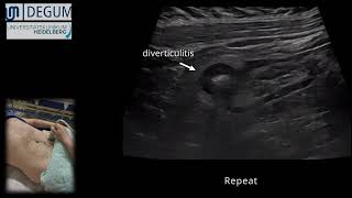 Episode 41 Uncomplicated sigmoid diverticulitis [upl. by Evvie481]