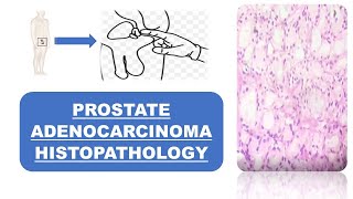 Prostate Adenocarcinoma Histopathology [upl. by Stefano]