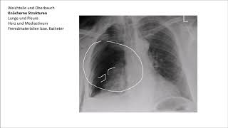 Röntgen Thorax Befundung [upl. by Halladba]