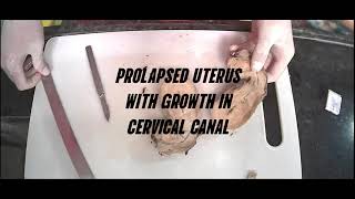 UTERUS GROSSING WITH CANCER [upl. by Alaehcim450]