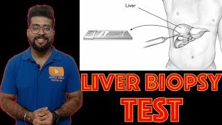 Liver Biopsy Test Explained in Hindi  Medical guruji [upl. by Oramug]