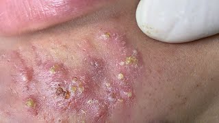 Big Cystic Acne Blackheads Extraction Blackheads amp Milia Whiteheads Removal Pimple Popping  324 [upl. by Libove]