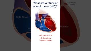 What are ventricular ectopic beats VPC [upl. by Areyk829]