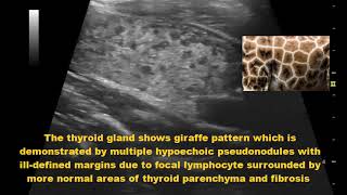 Hashimoto’s Thyroiditis Ultrasound giraffe pattern [upl. by Ylrebmek]