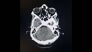 Aqueduct stenosispartial agenesis of corpus callosum residual effects of previous ischemia and HC [upl. by Nwahsear]