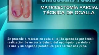 Tecnica Ogalla para Onicocriptosis en estadio IIa [upl. by Nnaeinahpets]