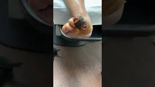 GANGRENE OF THE GREAT TOE😢😢😢 LET’S SAVE A LIMB TO SAVE A LIFE ❤️ [upl. by Fremont]