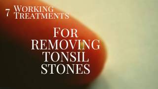 7 smashing treatments for Tonsil stone Removal [upl. by Anya252]