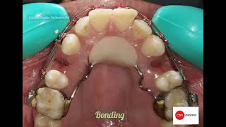 orthodontic treatment with only upper 1st premolar extraction upper 4 4 extracted [upl. by Mariand]