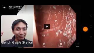 My Endoscopy video ACID REFLUX  GERD PART 2 answering question anxiety panic attack [upl. by Dione]