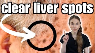 Get Rid Of Liver Spots FAST  Seborrheic Keratosis [upl. by Leandra]