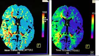 Video 1 of 3 How to interpret a Brain CT Perfusion Scan for acute stroke [upl. by Neufer]