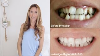 Invisalign Update 4  Progress Pics  Elastics [upl. by Okia]