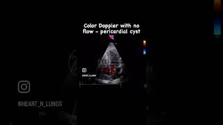 A pericardial cyst amp Color Doppler 💖 [upl. by Meehar]