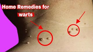 How to remove warts home remedies [upl. by Vaclav179]