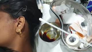 Preauricular sinus abscess aspiration Patient teaching programme English [upl. by Edlin]