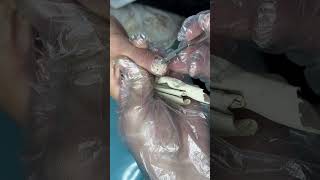 Treatment Callus and Dead skin Ep60 Sheng Clinic [upl. by Rabjohn183]