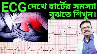 ECG দেখে হার্টের সমস্যা বুঝবেন কিভাবেHow to interpret ECGHow to read ECGElectrocardiogramECG [upl. by Earvin]